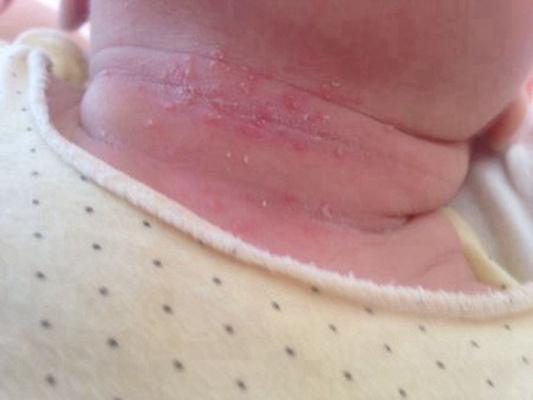 新生兒胎毒的症狀