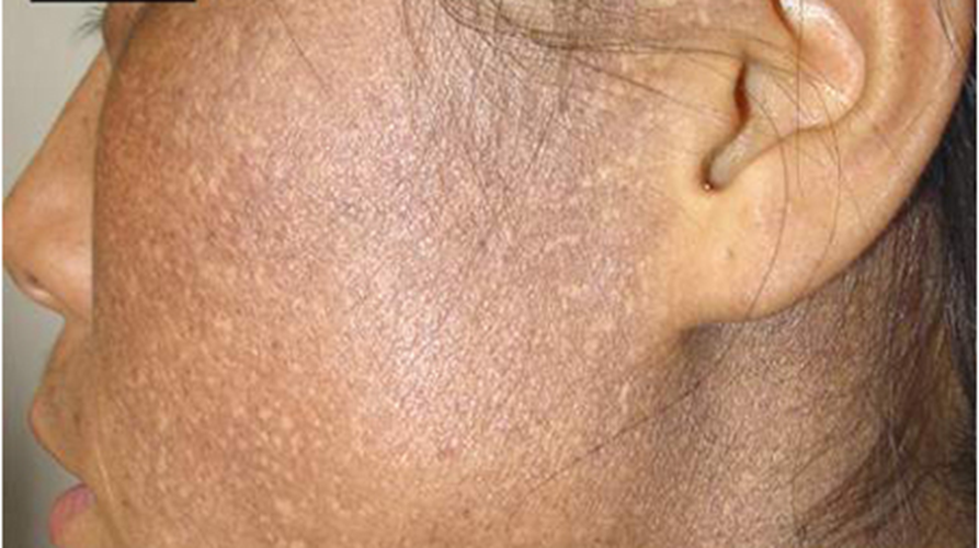 面部皮膚黑變病效果