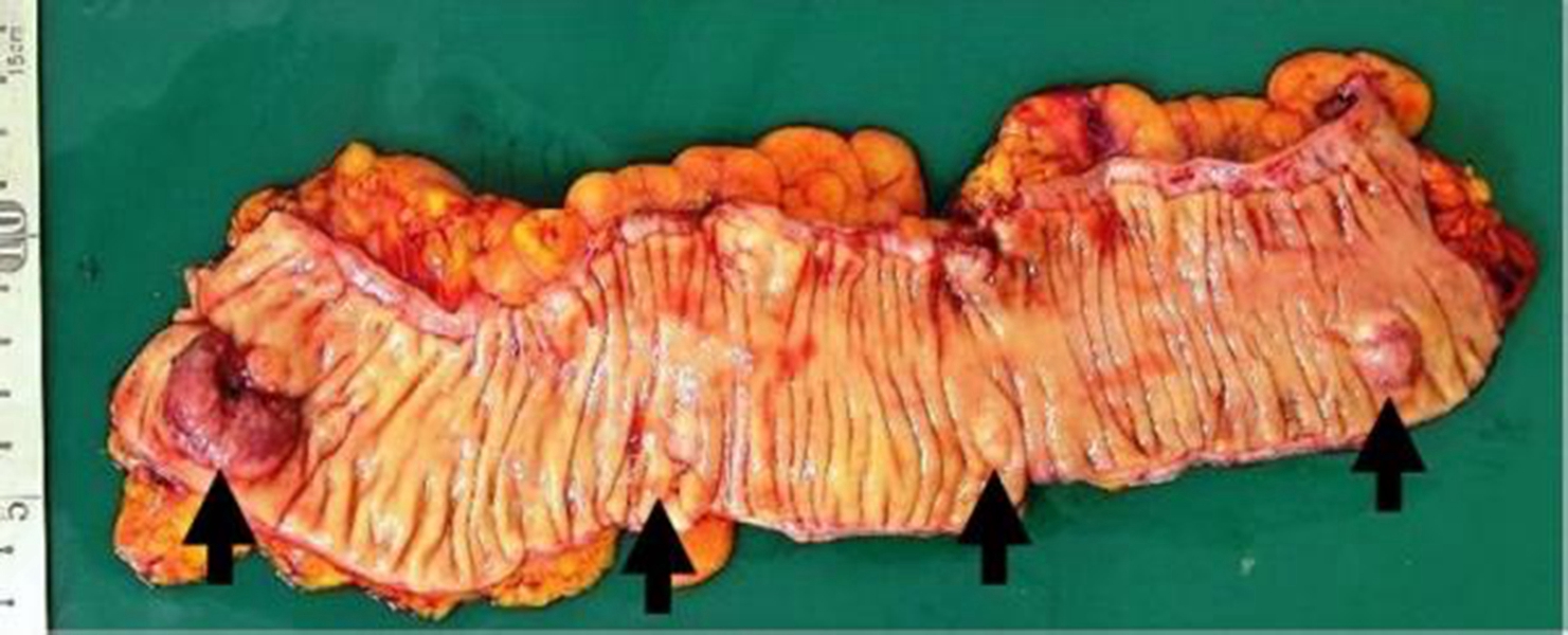 直腸腸腫瘤切除術後