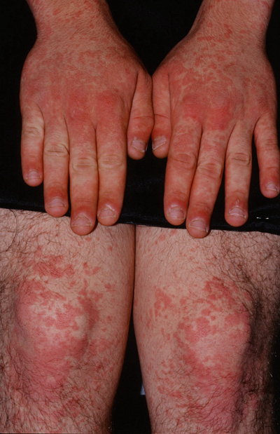 艾滋病紅疹症狀