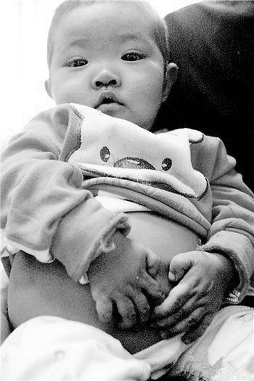 小孩患有腹水的