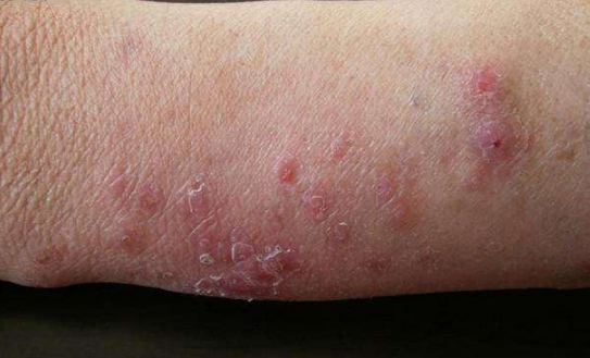 體股癬初期現象