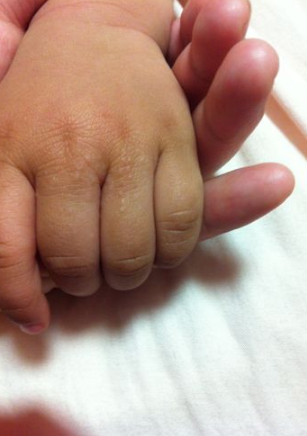 寶寶手上長水泡