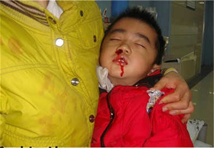 再生障礙性貧血嚴重流鼻血