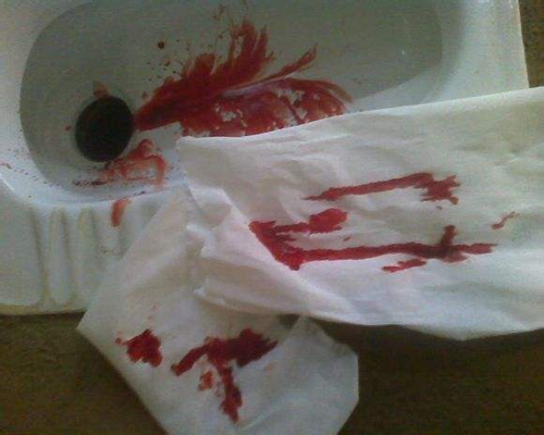 腸癌的症狀 (43) 