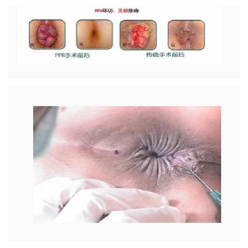肛周溼疹的手術對比
