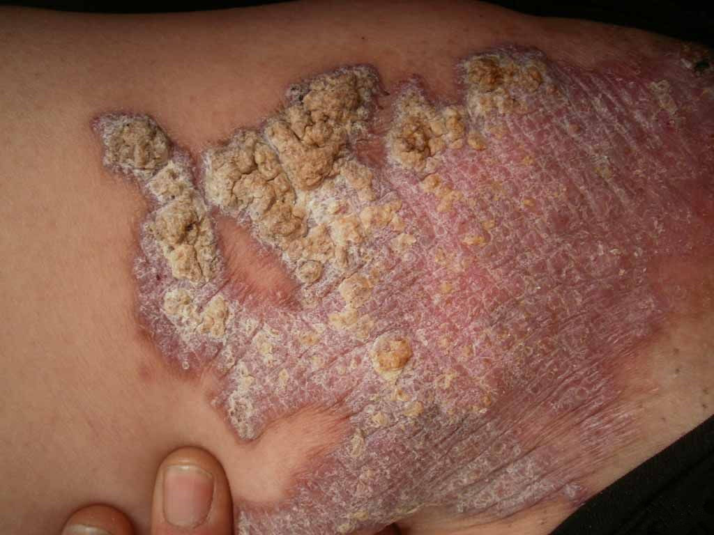 嚴重的皮膚結核病