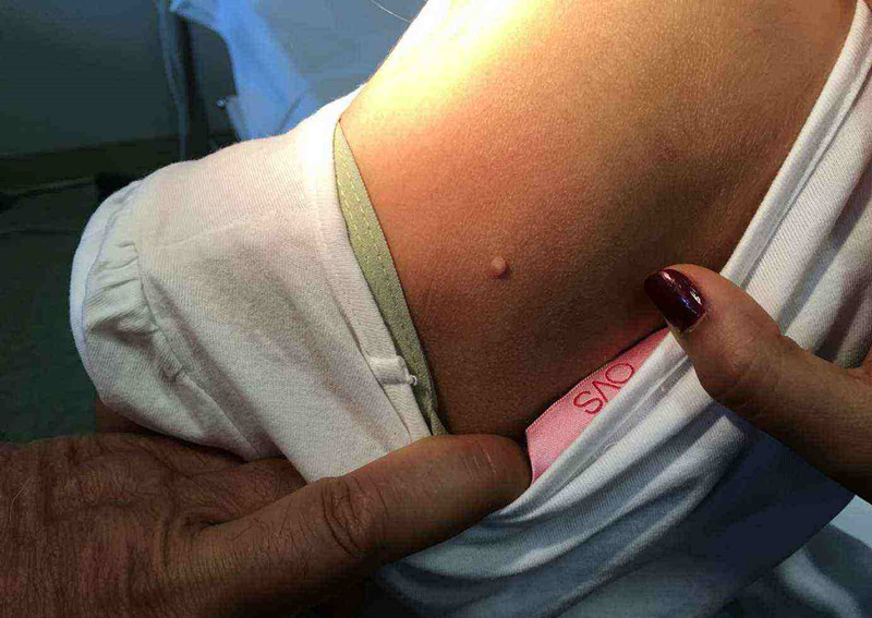 伊可爾傳染性軟疣 