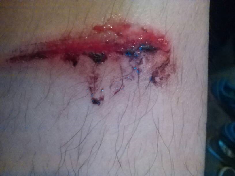 未打破傷風的傷口