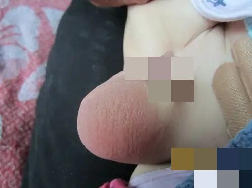 腹股溝斜疝 (57) 