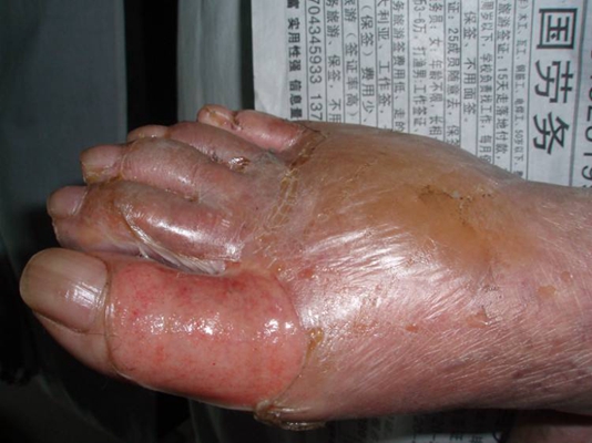 深二度燒傷 (46) 
