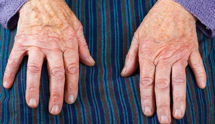 特發性震顫 (52) 