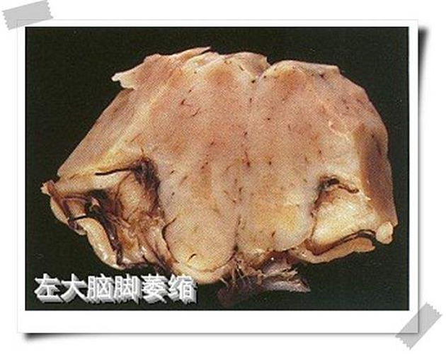 左大腦腳腦萎縮