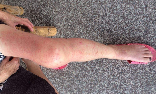 皮膚澱粉樣變 (42) 