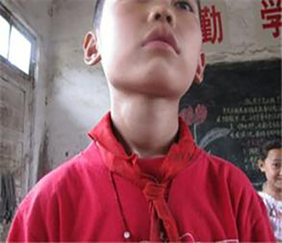 小孩甲狀腺腫大的