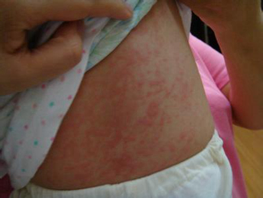嬰兒蕁麻疹 (42) 