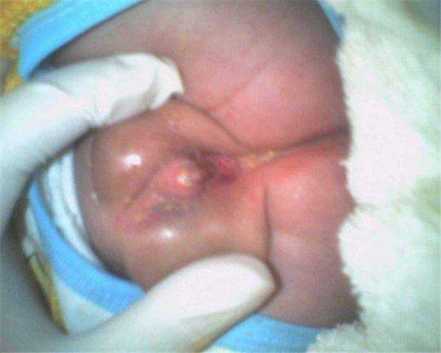 嬰幼兒男性假兩性畸形