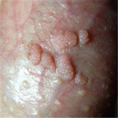 性病性淋巴肉芽腫套圖 (9) 