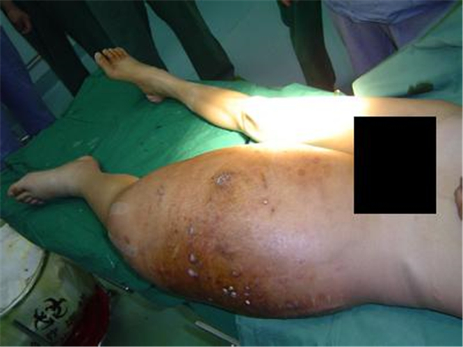 左腿巨大骨肉瘤