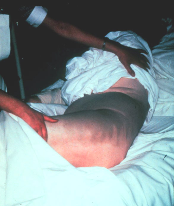 重症急性胰腺炎