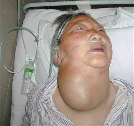 老人巨大甲狀腺結節住院