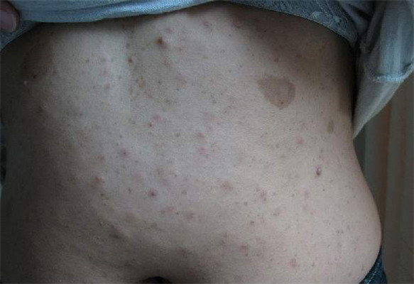 牛奶咖啡斑 (44) 