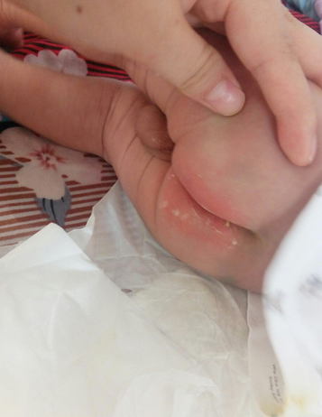 寶寶紅屁屁照片 (3) 