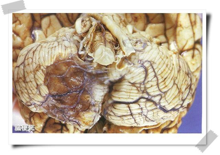 血栓導致腦梗塞