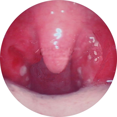 扁桃體癌圖  (60) 