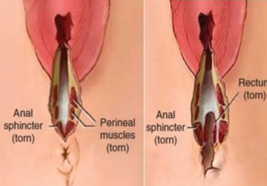 產科近期會陰撕裂縫和的