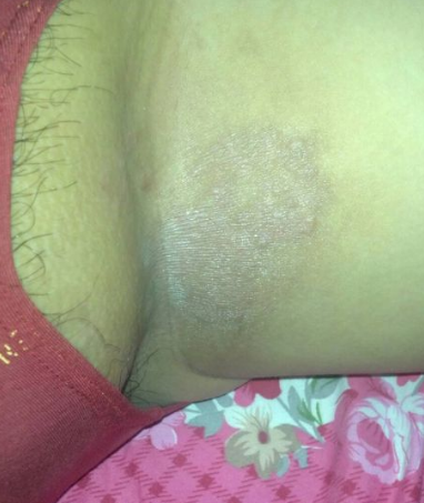 體股癬初期現象