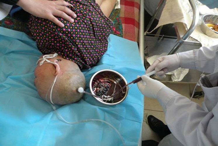 腦出血微創孔鑽引流術