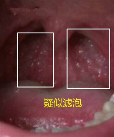 喉部淋巴濾泡增生 (37) 