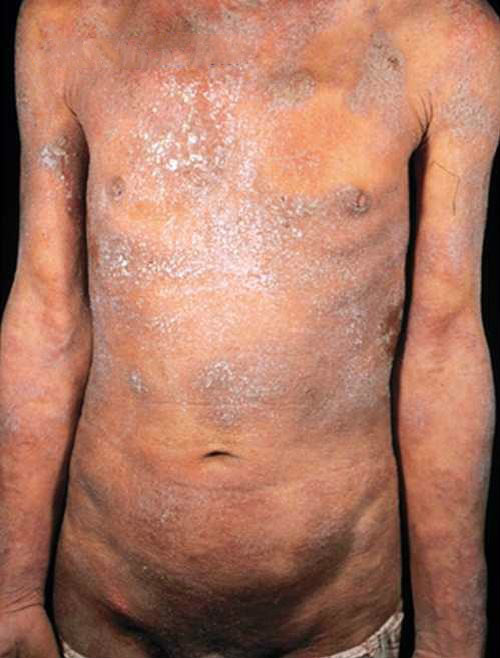 性病性淋巴肉芽腫套圖 (58) 