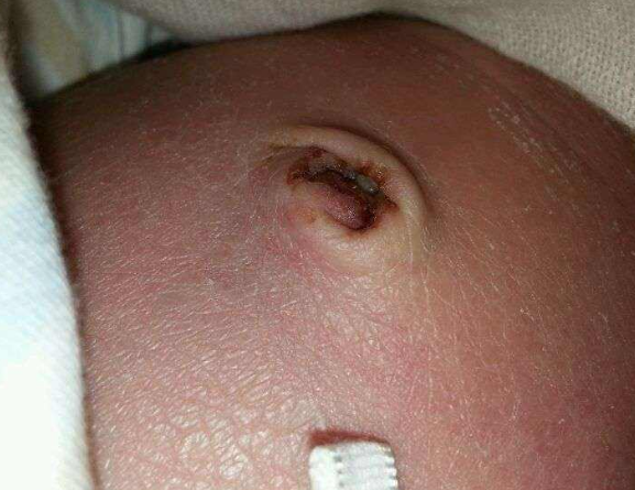 寶寶臍帶脫落後