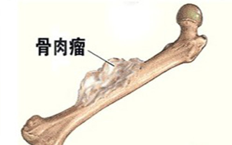 骨肉瘤 