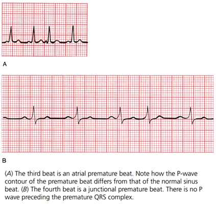 頻發房性早搏 (41) 