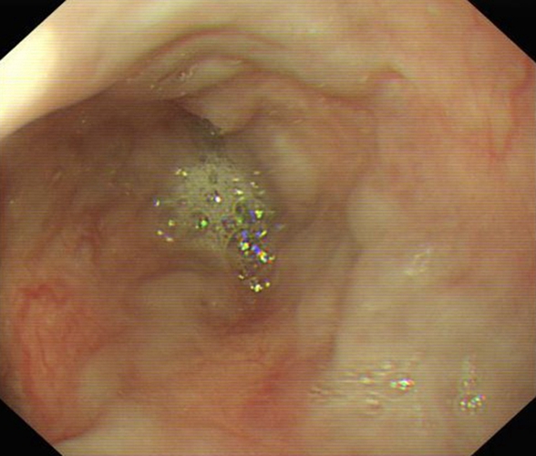 急性胃炎症狀表現的