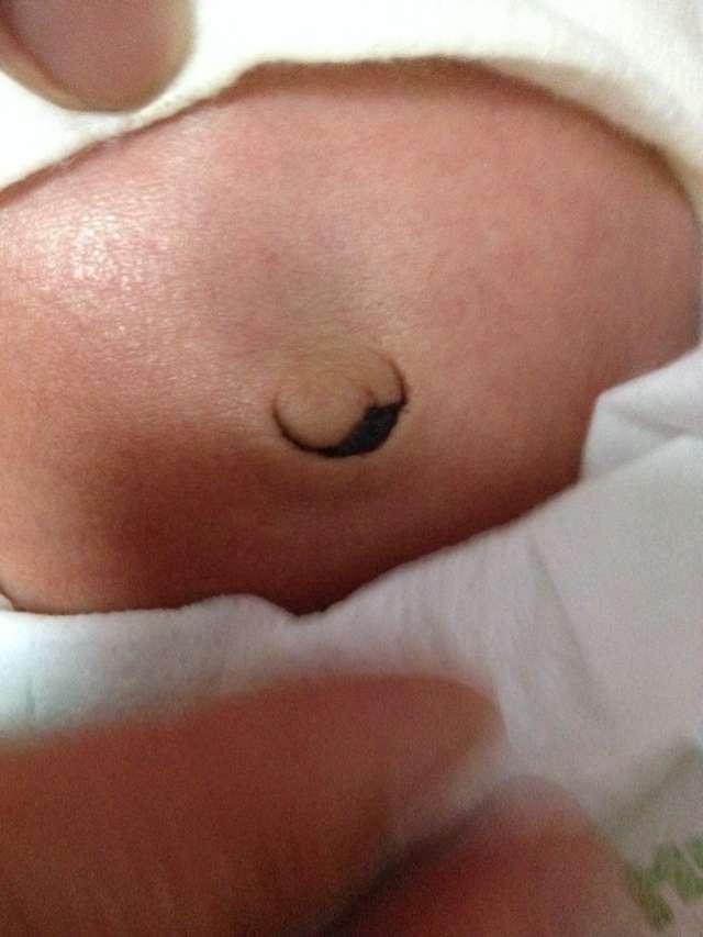 新生兒肚臍脫落圖 (42) 