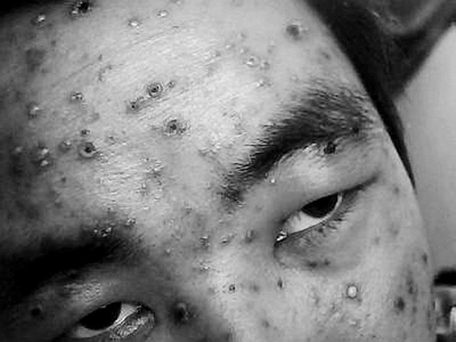 天花可以治療嗎