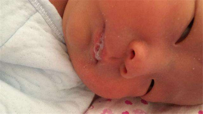 新生兒肺炎吐泡泡 (41) 