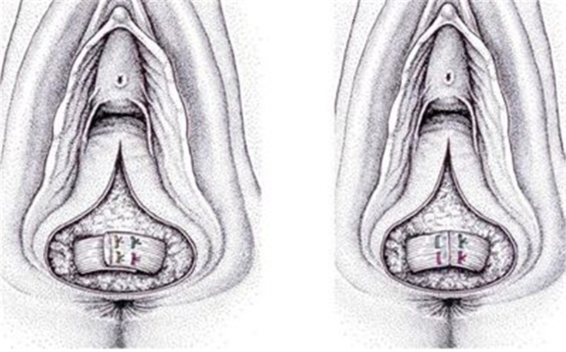 四度會陰撕裂縫合方法