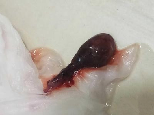 流產掉下來的孕囊