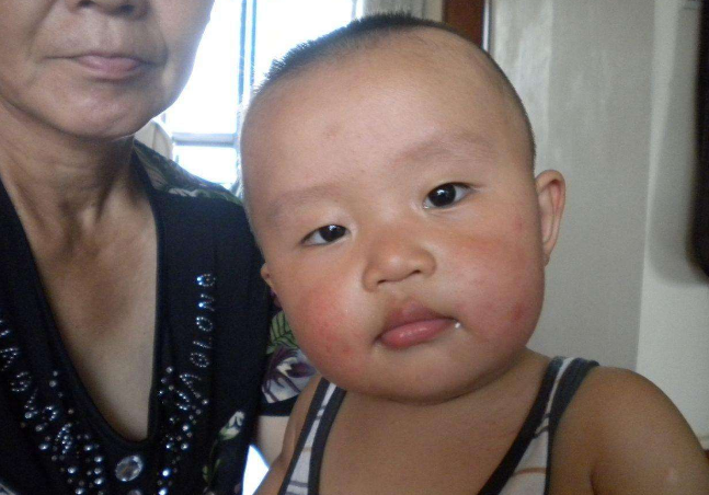 臉上皮膚過敏症狀