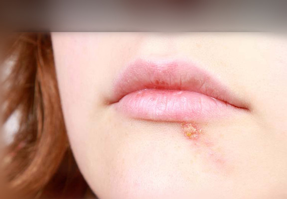 嘴上長皰疹 (42) 