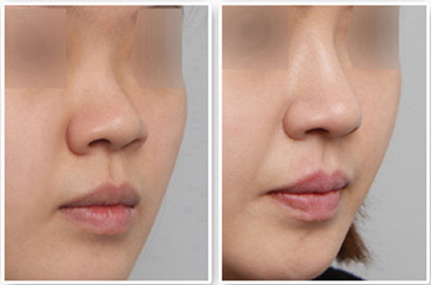 鼻子整形 (44) 