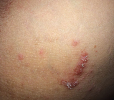 體股癬初期現象