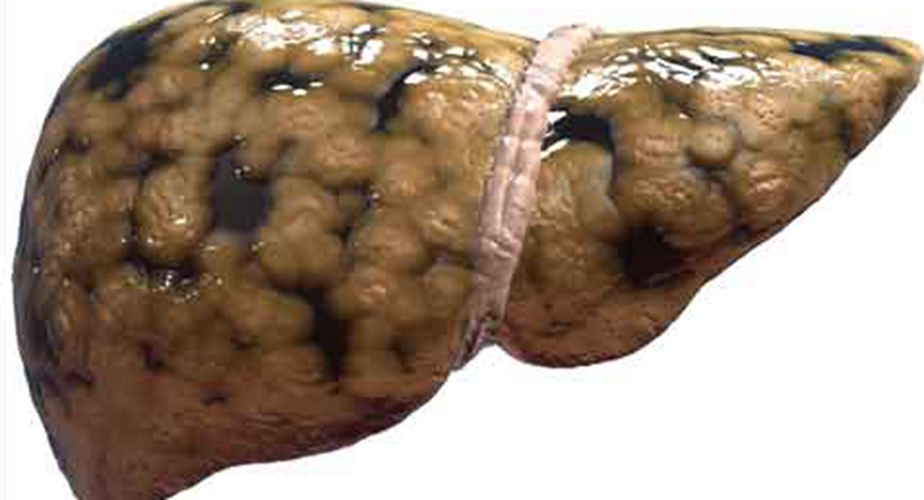  重度的酒精肝的併發症的