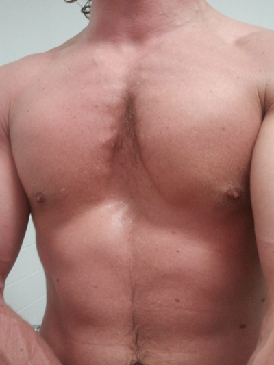 男生胸部突出 (8) 