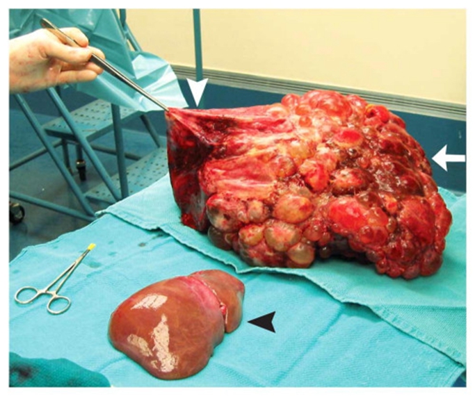 ＿特發性肺纖維化症狀